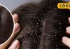 Winter dandruff prevention tips for healthy hair sa