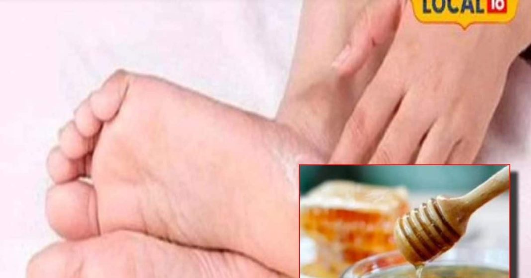 Cracked heels home natural remedies in winter home made cream – Bharat.one हिंदी