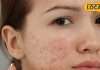 बार-बार निकलने लगते हैं कील-मुंहासे, तो इन बातों का रखें ध्यान, चमकने लगेगा चेहरा