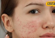 बार-बार निकलने लगते हैं कील-मुंहासे, तो इन बातों का रखें ध्यान, चमकने लगेगा चेहरा