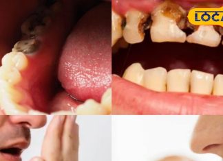 दांतों के कीड़े, दर्द और सड़न से हैं परेशान, अपनाएं ये नेचुरल घरेलू उपाय