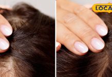 Hair Care Tips : झड़ते बालों से हैं परेशान, एक्सपर्ट से जानिए समाधान