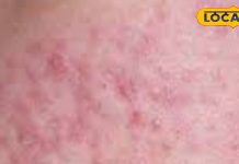 जब निकलने लगे मुंहासे तो इन बातों का रखें ध्यान, हो सकती है ये घातक बीमारी