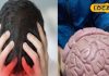 Migraine Treatment: सर्दियों में माइग्रेन के दर्द से कैसे पाएं राहत, किन बातों को ध्यान में रखना जरूरी? एक्सपर्ट ने दिया सुझाव