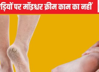 फटी एड़ियों में आप जो क्रीम लगाते हैं वह कोई काम की नहीं, स्किन के बड़े डॉक्टर से जान लीजिए इस बीमारी का इलाज, दवा भी बताया