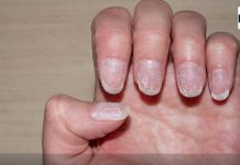 आपके नाखून में ऐसा तो नहीं है, यदि है तो इसके हैं 5 संकेत, सतर्क होने की है जरूरत
