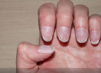 आपके नाखून में ऐसा तो नहीं है, यदि है तो इसके हैं 5 संकेत, सतर्क होने की है जरूरत