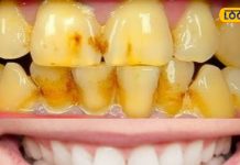 दांत पर चढ़ गई है पीली परत, तो अपनाएं ये नुस्खा,ब्रश-टूथपेस्ट भी हो जाएंगे फेल