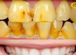 दांत पर चढ़ गई है पीली परत, तो अपनाएं ये नुस्खा,ब्रश-टूथपेस्ट भी हो जाएंगे फेल