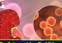 किडनी इंफेक्शन के लक्षण: जानें कारण और इलाज