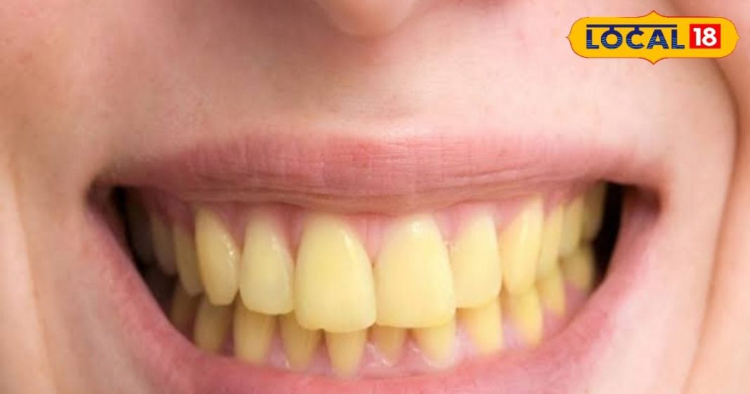 तंबाकू सिगरेट ने दांतों को कर दिया है पीला, रंगत में सुधार के लिए चबाएं ये पत्ते, चमक जाएगी बत्तीसी – Bharat.one हिंदी