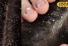 डैंड्रफ झट से खत्म हो जाएगा, बस इन आयुर्वेदिक टिप्स की लें मदद, जड़ से खत्म होगी समस्या! – Bharat.one हिंदी