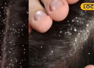 डैंड्रफ झट से खत्म हो जाएगा, बस इन आयुर्वेदिक टिप्स की लें मदद, जड़ से खत्म होगी समस्या! – Bharat.one हिंदी