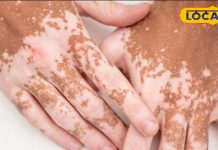 ल्यूकोडर्मा से हैं परेशान तो अपनाएं ये घरेलू नुस्खे, कुछ ही दिनों में दिखने लगेगा असर