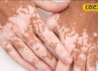 ल्यूकोडर्मा से हैं परेशान तो अपनाएं ये घरेलू नुस्खे, कुछ ही दिनों में दिखने लगेगा असर