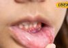 हल्के में न लें मुंह के छाले, तुरंत करा लें जांच वरना पछताएंगे