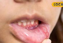 Mouth ulcers occur frequently what causes how to get rid of them know from doctor