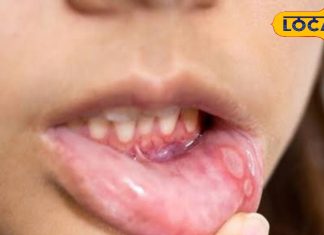 Mouth ulcers occur frequently what causes how to get rid of them know from doctor