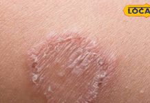 दाद खाज खुजली और जलन से आराम दिलाएंगे ये घरेलू नुस्खे