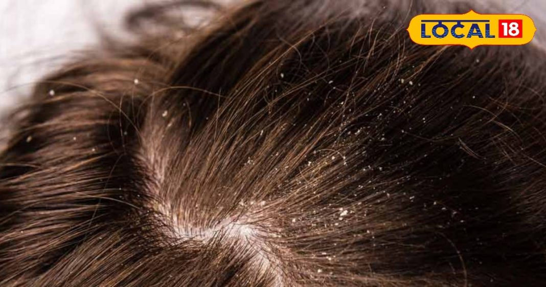 महंगे शैंपू की जगह अपनाएं ये घरेलू ट्रिक, बालों के डैंड्रफ से पाएं हमेशा की मुक्ति – Bharat.one हिंदी