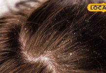 महंगे शैंपू की जगह अपनाएं ये घरेलू ट्रिक, बालों के डैंड्रफ से पाएं हमेशा की मुक्ति – Bharat.one हिंदी