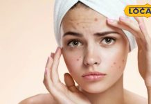 Beauty Tips : इस ट्रिक से नहीं आएंगे चेहरे पर पिंपल्स, बहुत आसान है ये रामबाण तरीका