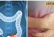 कोलोरेक्टल रोग: हैदराबाद के डॉक्टरों ने बताई समस्या की वजहें और रोकथाम.