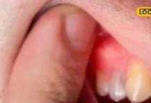 महंगी दवाओं को करें बाय-बाय…हल्दी, नमक, सरसों तेल से ऐसे करें पायरिया का इलाज, जानें तरीका