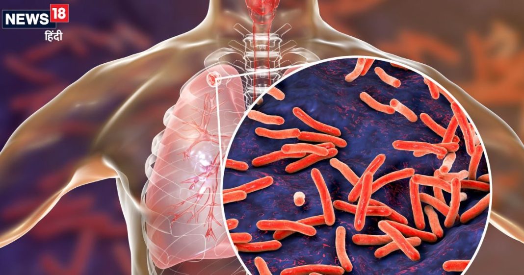 कोशिशों के बाद भी टीबी मरीजों के हालात चिंताजनक, 3 बड़े कारण बीमारी को बना रहे गंभीर, देखें ICMR की रिपोर्ट