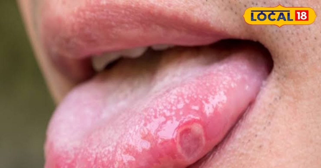 मुंह में पड़े छालों को ना करें नजर अंदाज, हो सकती है गंभीर बीमारी, जानें बचाव के उपाय – Bharat.one हिंदी