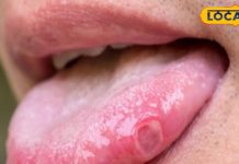मुंह में पड़े छालों को ना करें नजर अंदाज, हो सकती है गंभीर बीमारी, जानें बचाव के उपाय – Bharat.one हिंदी