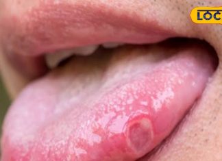 मुंह में पड़े छालों को ना करें नजर अंदाज, हो सकती है गंभीर बीमारी, जानें बचाव के उपाय – Bharat.one हिंदी