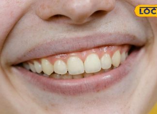 पीले दांतों से होना पड़ता है शर्मिंदा? अपनाएं ये टिप्स; सफेद मोतियों सी आएगी चमक – Bharat.one हिंदी