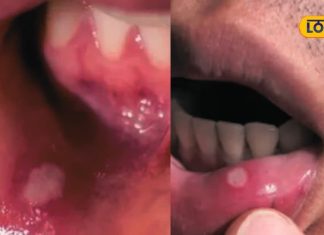 मुंह के छालों ने कर दिया है बेहाल? ट्राई करें ये 6 घरेलू नुस्खे… छूमंतर हो जाएगी समस्या