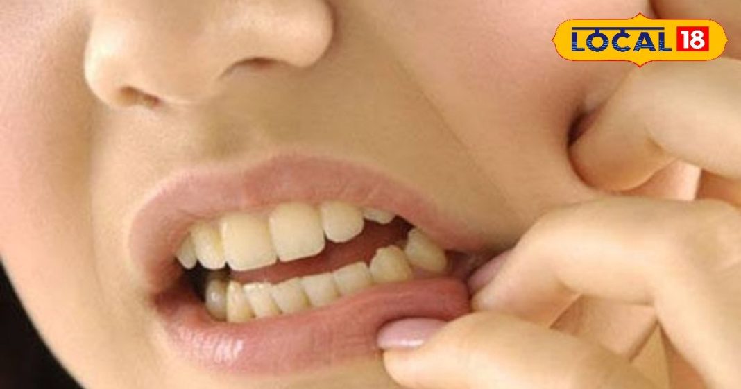 Home remedy for mouth ulcers: मुंह में हो गए हैं छाले, तो अपनाएं यह घरेलू नुस्खा, बहुत जल्दी मिलेगी आराम