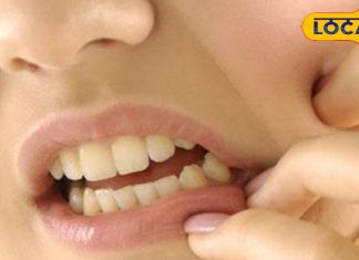Home remedy for mouth ulcers: मुंह में हो गए हैं छाले, तो अपनाएं यह घरेलू नुस्खा, बहुत जल्दी मिलेगी आराम