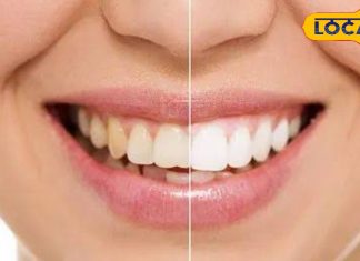 रायबरेली: सफेद और चमकदार दांत पाने के घरेलू नुस्खे.