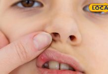 मुंह के छालों से हैं परेशान… टेंशन छोड़िए, अपनाएं ये घरेलू उपाय, तुरंत मिलेगा आराम