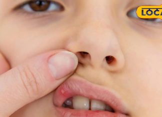 मुंह के छालों से हैं परेशान… टेंशन छोड़िए, अपनाएं ये घरेलू उपाय, तुरंत मिलेगा आराम