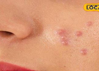 पिंपल से परेशान है आपका टीनएजर बच्चा, ये छोटा सा टुकड़ा एक हफ्ते में चमका देगा चेहरा