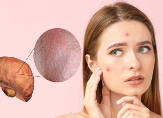 फैटी लीवर से हो सकती है त्वचा संबंधी समस्याएं: जानें लक्षण और उपाय.