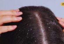 महंगे-महंगे शैंपू भी फेल! सिर्फ 7 दिन में बिना केमिकल कहें डैंड्रफ को अलविदा
