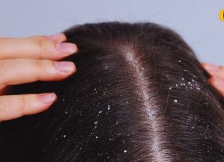 महंगे-महंगे शैंपू भी फेल! सिर्फ 7 दिन में बिना केमिकल कहें डैंड्रफ को अलविदा