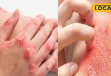 इस दिन व्रत करने से दूर होता है पुराने से पुराना त्वचा रोग! विधि-विधान से करें पूजा, नहीं आएगी समस्या!