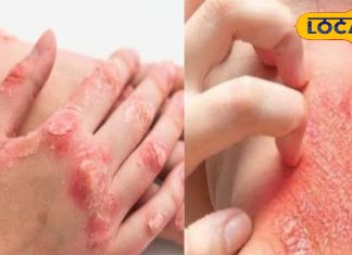 इस दिन व्रत करने से दूर होता है पुराने से पुराना त्वचा रोग! विधि-विधान से करें पूजा, नहीं आएगी समस्या!