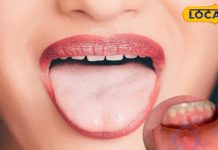 मुंह के छाले से हो गए हैं परेशान, ठीक कर देंगे ये घरेलू नुस्खे, एक ही दिन में होगा आराम