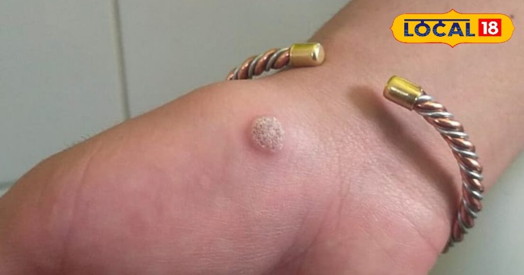 अल्मोड़ा में यहां इस विधि से हो रहा मस्सों का फ्री इलाज, एक महीने में मिल जाएगा छुटकारा