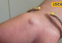 अल्मोड़ा में यहां इस विधि से हो रहा मस्सों का फ्री इलाज, एक महीने में मिल जाएगा छुटकारा