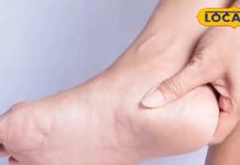 गर्मी में एड़ियों का दर्द दे रहा तकलीफ? रसोई से उठाइए ये 3 चीज़ें, जादू सा दिखेगा असर