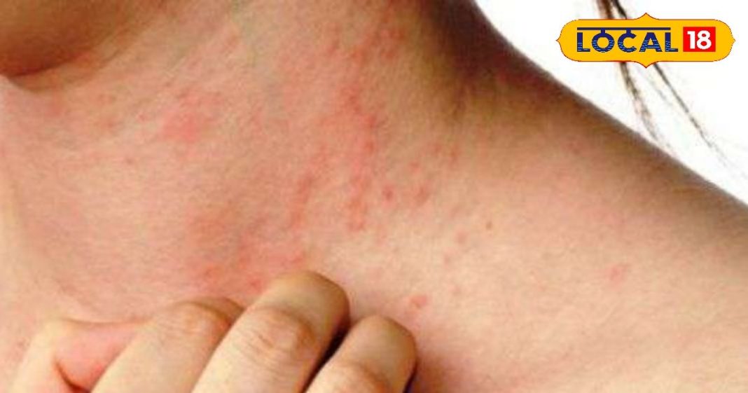 गर्मियों में हो जाती है दाद खाज खुजली, इस देसी नुस्खे से पाएं मुक्ति